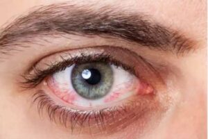 how to treat eye stroke naturally