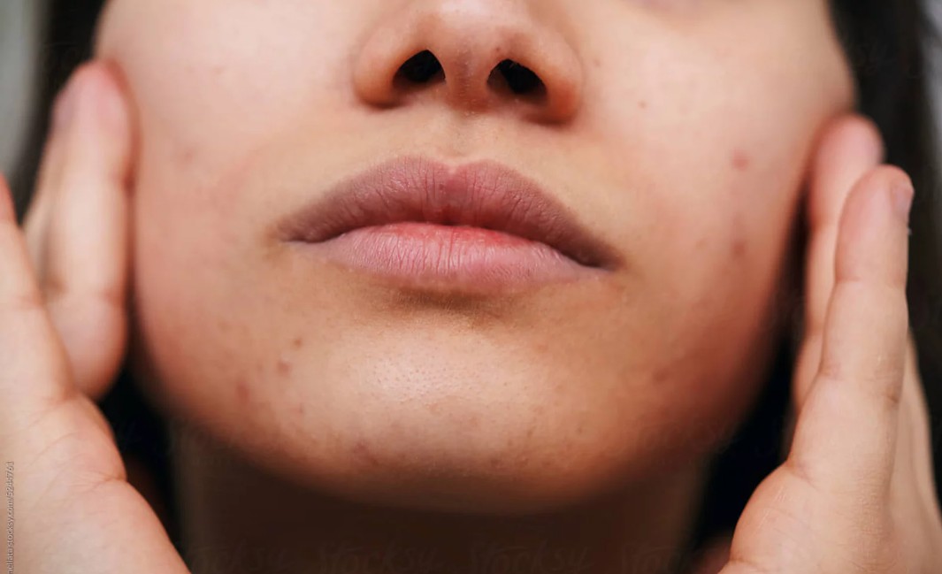 Things You Should Know About Blackhead Removal