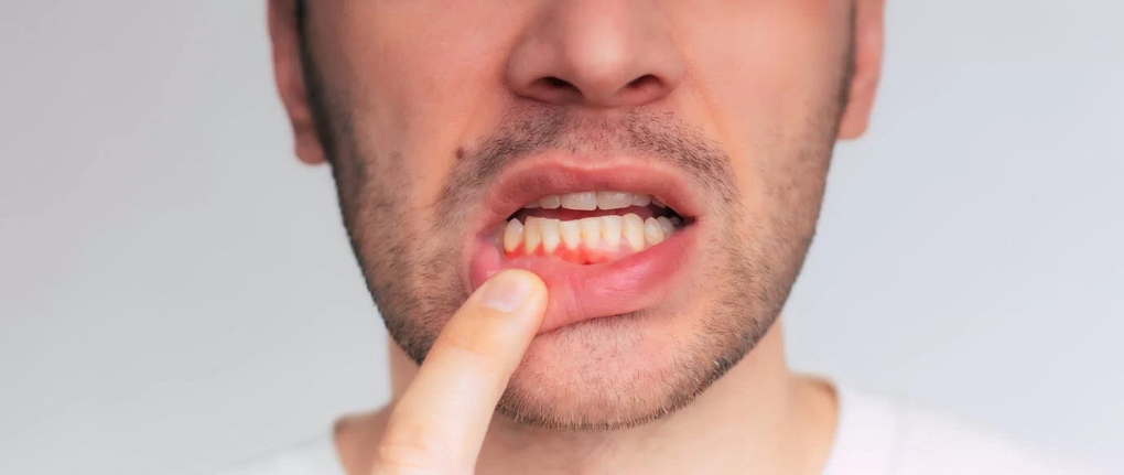 How to Treat Gingivitis at Home: 10 Effective Ways