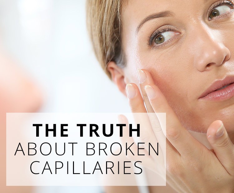What Are the Risks or Side Effects of Broken Capillaries Treatment?