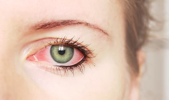 4 Interesting Facts About Dry Eye Disorder