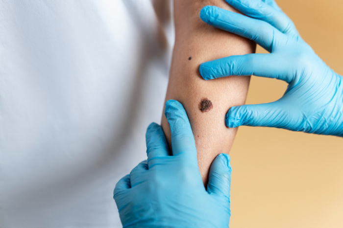 Metastatic Melanoma: 9 Self-Care Tips