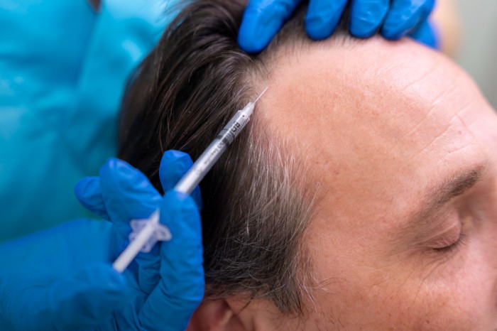 How to Reverse Balding: 12 Effective Ways to Regrow Hair