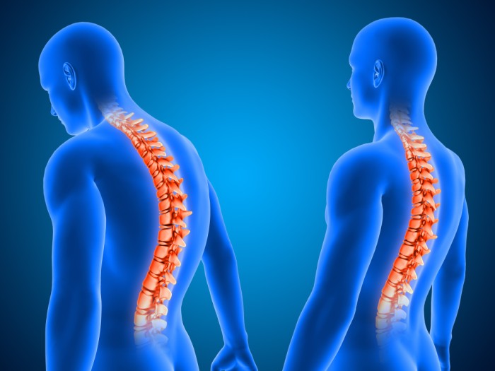 Ankylosing Spondylitis